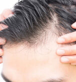 Saç Ekimi Kimler için uygun