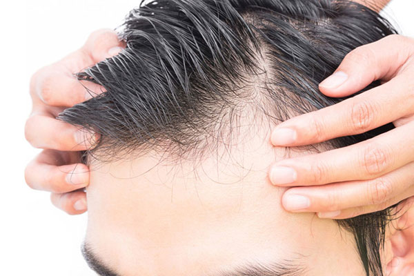 Saç Ekimi Kimler için uygun Saç Ekimi Kimler için uygun